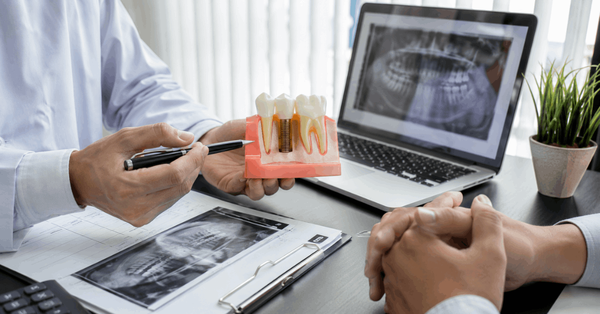 Descubre opciones asequibles de implantes dentales: compara precios y ahorra más